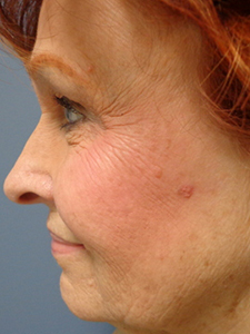 Skin Cancer Closure Before and After Pictures Nashville, TN