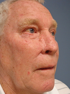 Skin Cancer Closure Before and After Pictures Nashville, TN