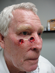 Skin Cancer Closure Before and After Pictures Nashville, TN