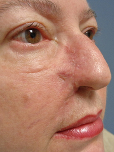 Skin Cancer Closure Before and After Pictures Nashville, TN