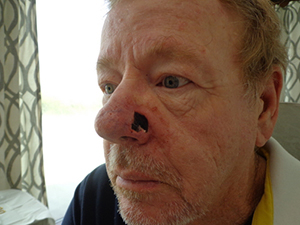 Skin Cancer Closure Before and After Pictures Nashville, TN