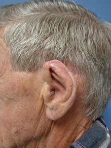Skin Cancer Closure Before and After Pictures Nashville, TN