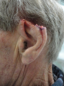 Skin Cancer Closure Before and After Pictures Nashville, TN