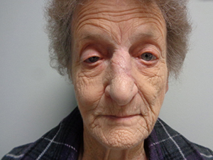 Skin Cancer Closure Before and After Pictures Nashville, TN