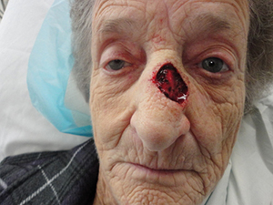 Skin Cancer Closure Before and After Pictures Nashville, TN