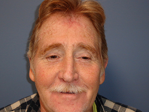Skin Cancer Closure Before and After Pictures Nashville, TN