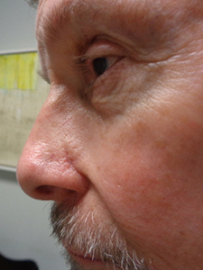 Skin Cancer Closure Before and After Pictures Nashville, TN