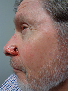 Skin Cancer Closure Before and After Pictures Nashville, TN