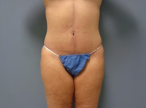 Tummy Tuck Before and After Pictures Nashville, TN