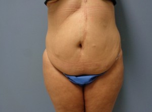 Tummy Tuck Before and After Pictures Nashville, TN
