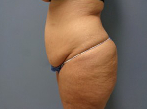 Tummy Tuck Before and After Pictures Nashville, TN