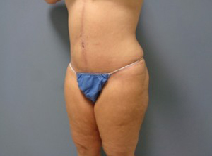Tummy Tuck Before and After Pictures Nashville, TN