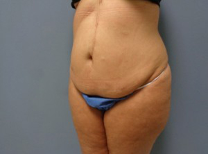 Tummy Tuck Before and After Pictures Nashville, TN