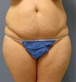 Tummy Tuck Before and After Pictures Nashville, TN
