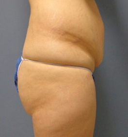 Tummy Tuck Before and After Pictures Nashville, TN