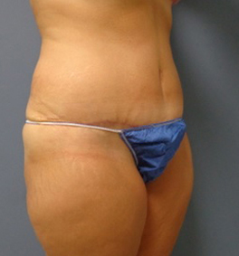 Tummy Tuck Before and After Pictures Nashville, TN