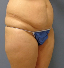 Tummy Tuck Before and After Pictures Nashville, TN