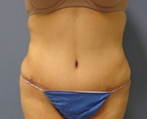 Tummy Tuck Before and After Pictures Nashville, TN