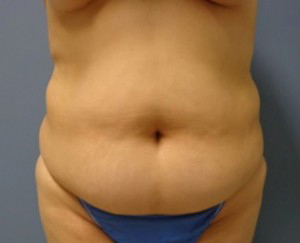 Tummy Tuck Before and After Pictures Nashville, TN