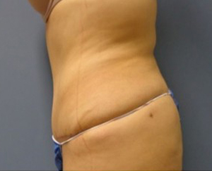 Tummy Tuck Before and After Pictures Nashville, TN