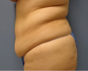 Tummy Tuck Before and After Pictures Nashville, TN