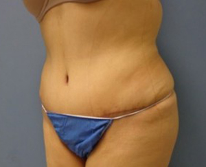 Tummy Tuck Before and After Pictures Nashville, TN