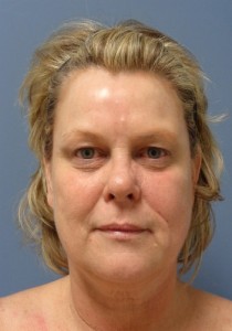 Facelift Before and After Pictures Nashville, TN