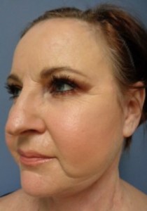 Facelift Before and After Pictures Nashville, TN