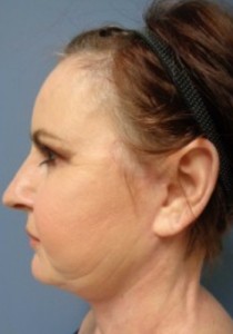 Facelift Before and After Pictures Nashville, TN