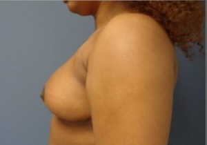 Breast Reduction Before and After Pictures Nashville, TN