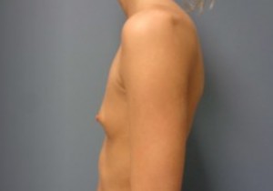 Breast Augmentation Before and After Pictures Nashville, TN