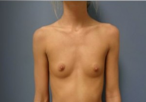 Breast Augmentation Before and After Pictures Nashville, TN