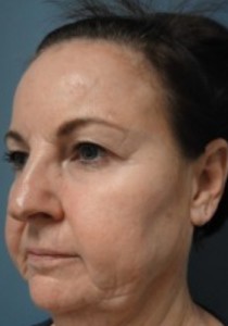 Facelift Before and After Pictures Nashville, TN