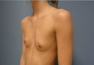 Breast Augmentation Before and After Pictures Nashville, TN