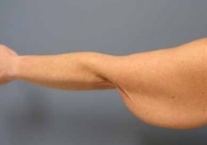 Arm Lift Before and After Pictures Nashville, TN