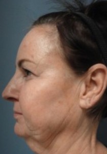 Facelift Before and After Pictures Nashville, TN