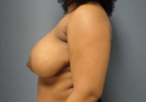 Breast Reduction Before and After Pictures Nashville, TN
