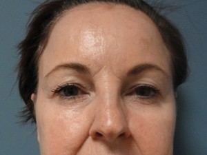 Blepharoplasty Before and After Pictures Nashville, TN