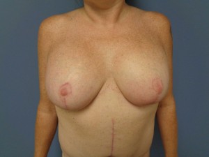 Breast Augmentation Before and After Pictures Nashville, TN