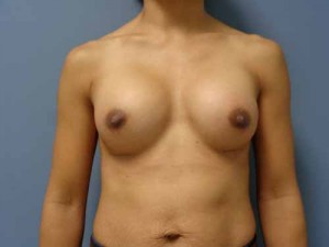 Breast Augmentation Before and After Pictures Nashville, TN