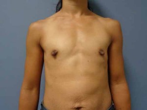 Breast Augmentation Before and After Pictures Nashville, TN