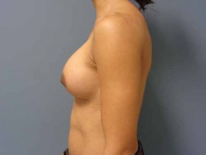 Breast Augmentation Before and After Pictures Nashville, TN