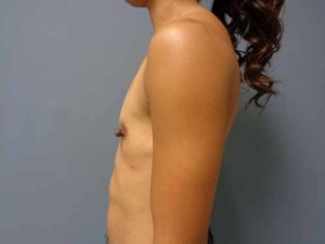 Breast Augmentation Before and After Pictures Nashville, TN