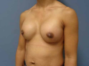 Breast Augmentation Before and After Pictures Nashville, TN