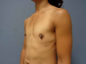 Breast Augmentation Before and After Pictures Nashville, TN