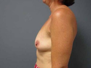 Breast Reconstruction Before and After Pictures Nashville, TN