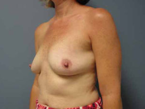 Breast Reconstruction Before and After Pictures Nashville, TN