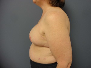 Breast Reconstruction Before and After Pictures Nashville, TN