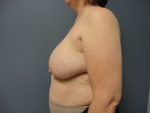 Breast Reconstruction Before and After Pictures Nashville, TN