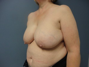 Breast Reconstruction Before and After Pictures Nashville, TN